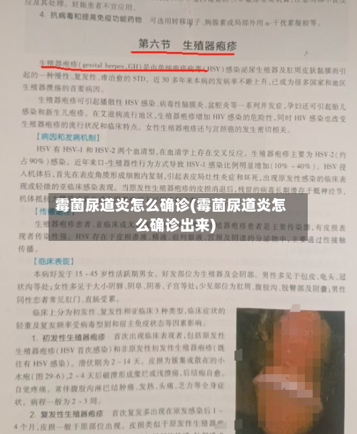 霉菌尿道炎怎么确诊(霉菌尿道炎怎么确诊出来)-第3张图片