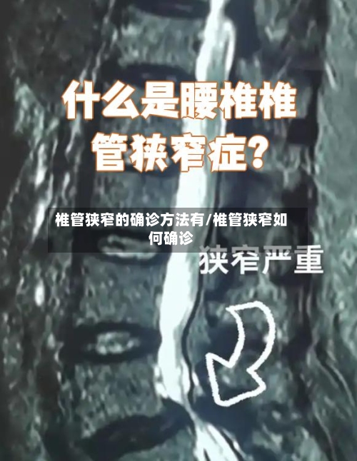 椎管狭窄的确诊方法有/椎管狭窄如何确诊