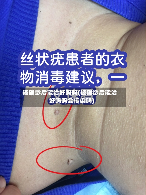 被确诊后能治好吗吗(被确诊后能治好吗吗会传染吗)