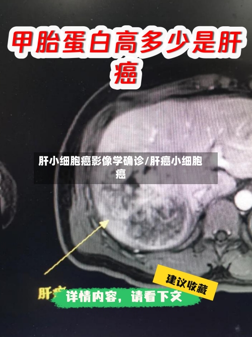 肝小细胞癌影像学确诊/肝癌小细胞癌