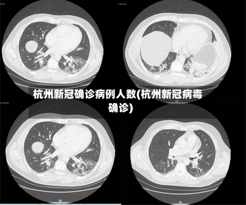 杭州新冠确诊病例人数(杭州新冠病毒确诊)