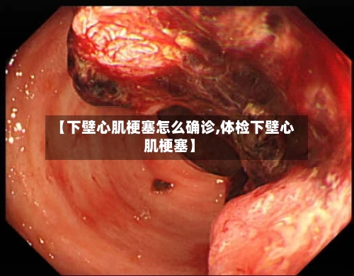 【下壁心肌梗塞怎么确诊,体检下壁心肌梗塞】-第2张图片