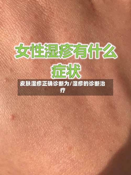 皮肤湿疹正确诊断为/湿疹的诊断治疗-第2张图片