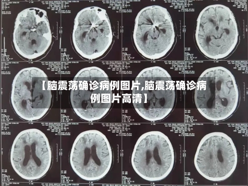 【脑震荡确诊病例图片,脑震荡确诊病例图片高清】-第3张图片