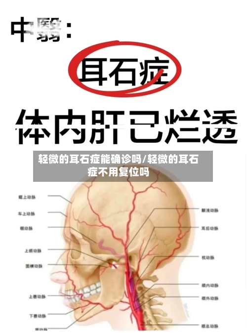 轻微的耳石症能确诊吗/轻微的耳石症不用复位吗-第2张图片