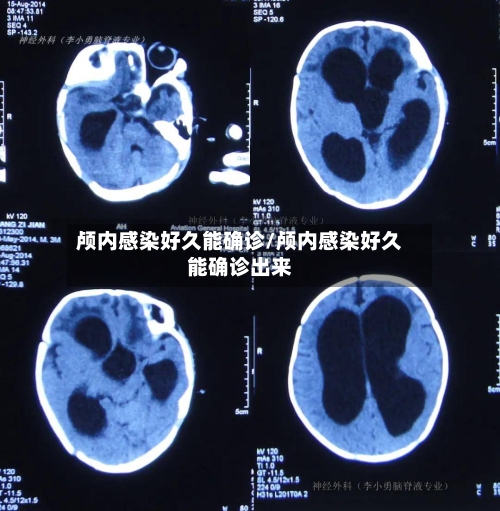 颅内感染好久能确诊/颅内感染好久能确诊出来