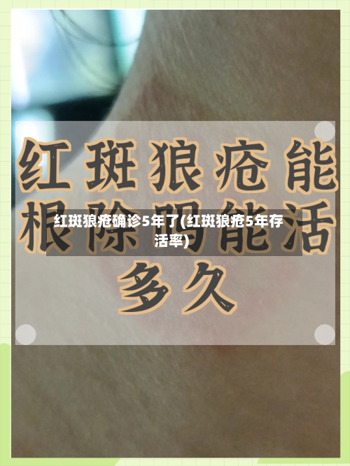 红斑狼疮确诊5年了(红斑狼疮5年存活率)