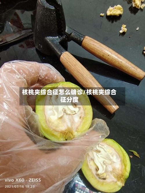核桃夹综合征怎么确诊/核桃夹综合征分度-第1张图片