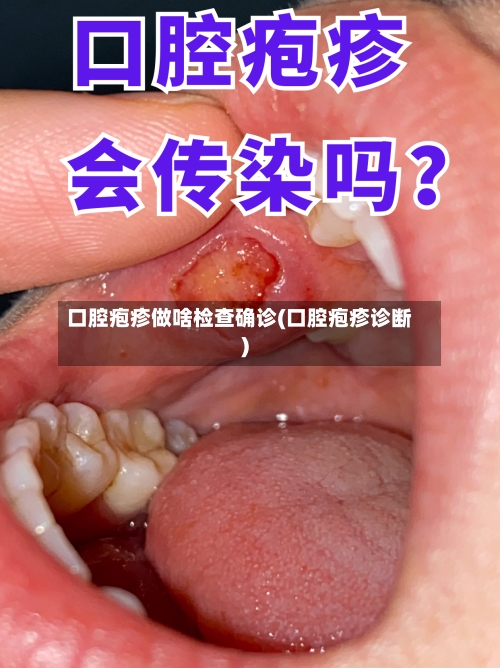 口腔疱疹做啥检查确诊(口腔疱疹诊断)