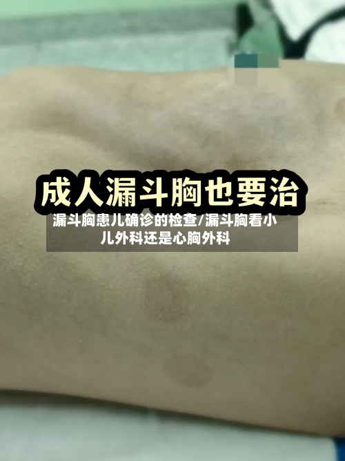 漏斗胸患儿确诊的检查/漏斗胸看小儿外科还是心胸外科-第3张图片
