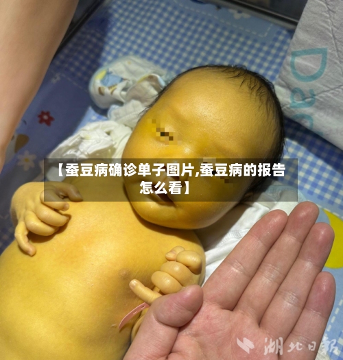 【蚕豆病确诊单子图片,蚕豆病的报告怎么看】-第2张图片