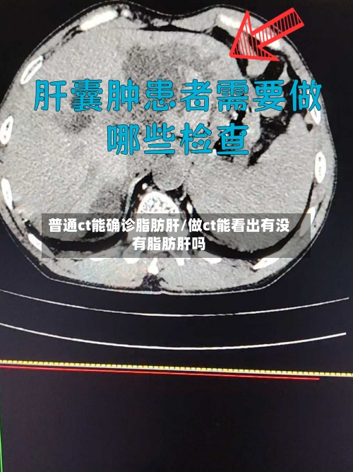 普通ct能确诊脂肪肝/做ct能看出有没有脂肪肝吗
