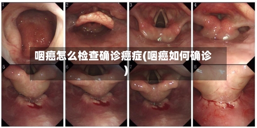 咽癌怎么检查确诊癌症(咽癌如何确诊)-第2张图片