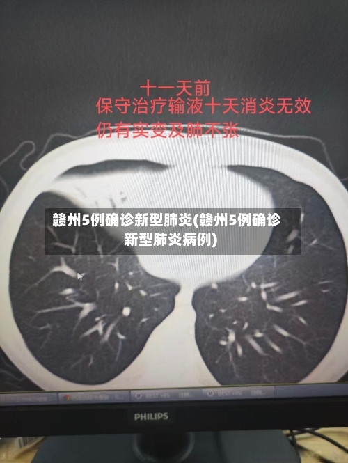 赣州5例确诊新型肺炎(赣州5例确诊新型肺炎病例)-第2张图片